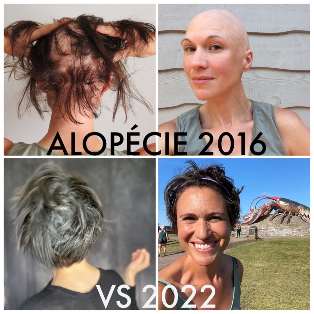 alopécie – La tête libre